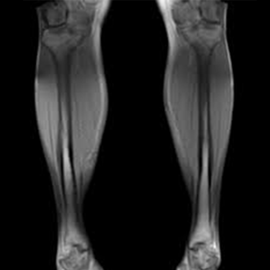 MRI Both Legs